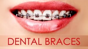 Tips on Getting Cheap Yet Quality Braces